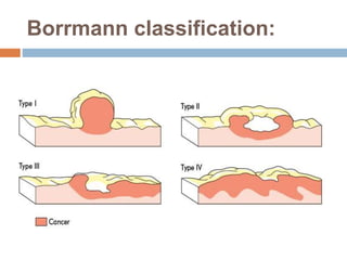 Boreman Classification gastric cancer | PPTX