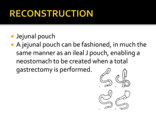  Jejunal pouch
 A jejunal pouch can be fashioned, in much the
same manner as an ileal J pouch, enabling a
neostomach to be created when a total
gastrectomy is performed.
 
