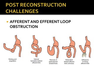  AFFERENT AND EFFERENT LOOP
OBSTRUCTION
 