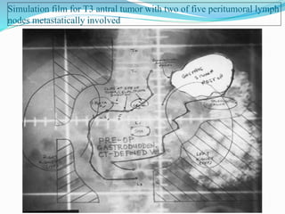 Simulation film for T3 antral tumor with two of five peritumoral lymph
nodes metastatically involved
 