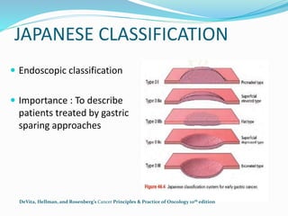 JAPANESE CLASSIFICATION
 Endoscopic classification
 Importance : To describe
patients treated by gastric
sparing approaches
DeVita, Hellman, and Rosenberg’s Cancer Principles & Practice of Oncology 10th edition
 