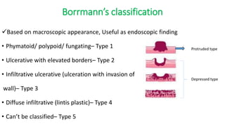 Boreman Classification Ca stomach | PPTX