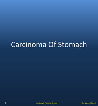 Dr. Naveed AshrafRadiologic Pictorial Review
Carcinoma Of Stomach
1
 