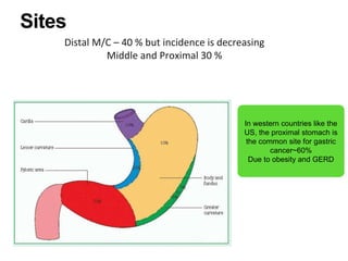 Sites
In western countries like the
US, the proximal stomach is
the common site for gastric
cancer~60%
Due to obesity and GERD
Distal M/C – 40 % but incidence is decreasing
Middle and Proximal 30 %
 