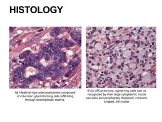 HISTOLOGY
A) Intestinal-type adenocarcinoma composed
of columnar, gland-forming cells infiltrating
through desmoplastic stroma.
B) In diffuse tumors, signet-ring cells can be
recognized by their large cytoplasmic mucin
vacuoles and peripherally displaced, crescent-
shaped, thin nuclei
 