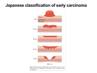 Japanese classification of early carcinoma
 
