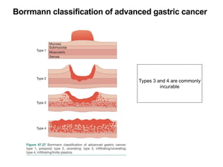 Borrmann classification of advanced gastric cancer
Types 3 and 4 are commonly
incurable
 