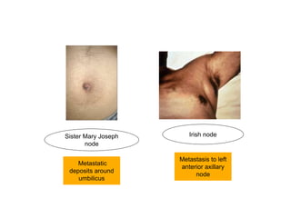 Sister Mary Joseph
node
Irish node
Metastatic
deposits around
umbilicus
Metastasis to left
anterior axillary
node
 