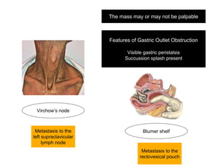 Virchow’s node
Metastasis to the
left supraclavicular
lymph node
Features of Gastric Outlet Obstruction
Visible gastric peristalsis
Succussion splash present
The mass may or may not be palpable
Blumer shelf
Metastasis to the
rectovesical pouch
 