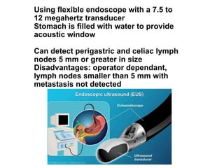 Using flexible endoscope with a 7.5 to
12 megahertz transducer
Stomach is filled with water to provide
acoustic window
Can detect perigastric and celiac lymph
nodes 5 mm or greater in size
Disadvantages: operator dependant,
lymph nodes smaller than 5 mm with
metastasis not detected
 