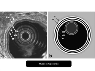 Muscle is hypoechoic
 