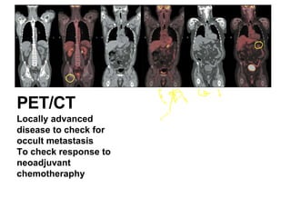 PET/CT
Locally advanced
disease to check for
occult metastasis
To check response to
neoadjuvant
chemotheraphy
 