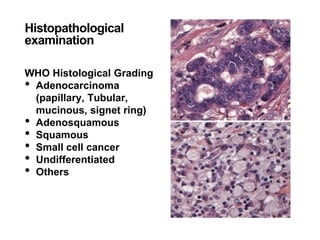 Histopathological
examination
WHO Histological Grading
• Adenocarcinoma
(papillary, Tubular,
mucinous, signet ring)
• Adenosquamous
• Squamous
• Small cell cancer
• Undifferentiated
• Others
 