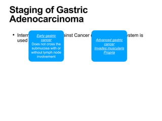 Staging of Gastric
Adenocarcinoma
• International union against Cancer (UICC) staging system is
used
Early gastric
cancer
Does not cross the
submucosa with or
without lymph node
involvement
Advanced gastric
cancer
Invades muscularis
Propria
 