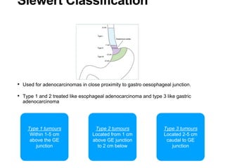 Siewert Classification
• Used for adenocarcinomas in close proximity to gastro oesophageal junction.
• Type 1 and 2 treated like esophageal adenocarcinoma and type 3 like gastric
adenocarcinoma
Type 2 tumours
Located from 1 cm
above GE junction
to 2 cm below
Type 1 tumours
Within 1-5 cm
above the GE
junction
Type 3 tumours
Located 2-5 cm
caudal to GE
junction
 
