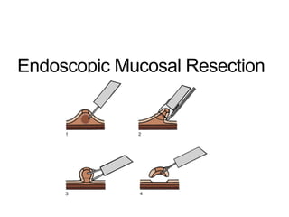 Endoscopic Mucosal Resection
 