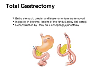 Total Gastrectomy
• Entire stomach, greater and lesser omentum are removed
• Indicated in proximal lesions of the fundus, body and cardia
• Reconstruction by Roux en Y eosophagojejunostomy
 