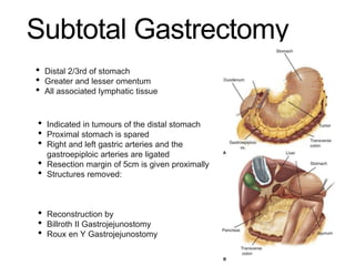 Subtotal Gastrectomy
• Indicated in tumours of the distal stomach
• Proximal stomach is spared
• Right and left gastric arteries and the
gastroepiploic arteries are ligated
• Resection margin of 5cm is given proximally
• Structures removed:
• Reconstruction by
• Billroth II Gastrojejunostomy
• Roux en Y Gastrojejunostomy
• Distal 2/3rd of stomach
• Greater and lesser omentum
• All associated lymphatic tissue
 