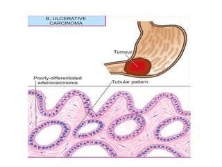 Carcinoma Of Stomach Pathology Ppt By PDF