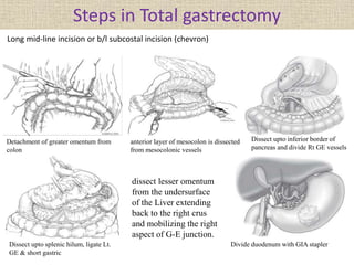 Steps in Total gastrectomy
Long mid-line incision or b/l subcostal incision (chevron)
Detachment of greater omentum from
colon
anterior layer of mesocolon is dissected
from mesocolonic vessels
Dissect upto inferior border of
pancreas and divide Rt GE vessels
Dissect upto splenic hilum, ligate Lt.
GE & short gastric
dissect lesser omentum
from the undersurface
of the Liver extending
back to the right crus
and mobilizing the right
aspect of G-E junction.
Divide duodenum with GIA stapler
 