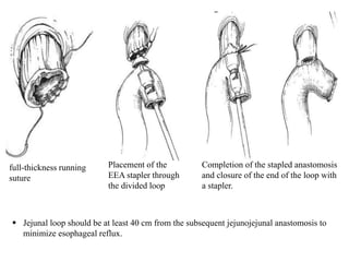 full-thickness running
suture
Placement of the
EEA stapler through
the divided loop
Completion of the stapled anastomosis
and closure of the end of the loop with
a stapler.
 Jejunal loop should be at least 40 cm from the subsequent jejunojejunal anastomosis to
minimize esophageal reflux.
 