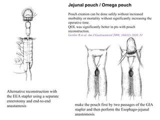 Alternative reconstruction with
the EEA stapler using a separate
enrerotomy and end-to-end
anastamosis
Jejunal pouch / Omega pouch
Pouch creation can be done safely without increased
morbidity or mortality without significantly increasing the
operative time.
QOL was significantly better in pts with pouch
reconstruction.
Gertler R et al. Am J Gastroenterol 2009; 104(11):2838–51
make the pouch first by two passages of the GIA
stapler and then perform the Esophago-jejunal
anastomosis
 