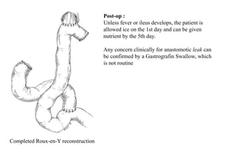 Completed Roux-en-Y reconstruction
Post-op :
Unless fever or ileus develops, the patient is
allowed ice on the 1st day and can be given
nutrient by the 5th day.
Any concern clinically for anastomotic leak can
be confirmed by a Gastrografin Swallow, which
is not routine
 