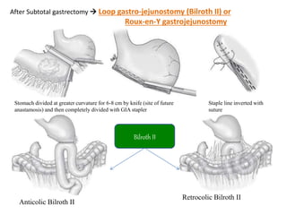 After Subtotal gastrectomy  Loop gastro-jejunostomy (Bilroth II) or
Roux-en-Y gastrojejunostomy
Stomach divided at greater curvature for 6-8 cm by knife (site of future
anastamosis) and then completely divided with GIA stapler
Staple line inverted with
suture
Anticolic Bilroth II
Retrocolic Bilroth II
Bilroth II
 