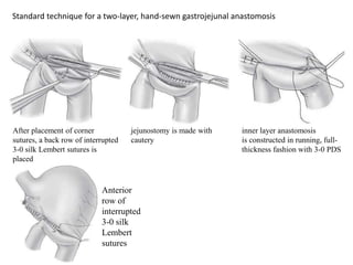 Standard technique for a two-layer, hand-sewn gastrojejunal anastomosis
After placement of corner
sutures, a back row of interrupted
3-0 silk Lembert sutures is
placed
jejunostomy is made with
cautery
inner layer anastomosis
is constructed in running, full-
thickness fashion with 3-0 PDS
Anterior
row of
interrupted
3-0 silk
Lembert
sutures
 