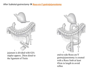 After Subtotal gastrectomy  Roux-en-Y gastrojejunostomy
jejunum is divided with GIA
stapler approx. 20cm distal to
the ligament of Treitz
end-to-side Roux-en-Y
gastrojejunostomy is created
with a Roux limb at least
45cm in length to avoid
reflux
 