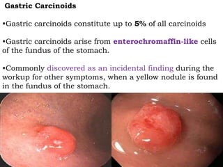 Gastric Carcinoids
•Gastric carcinoids constitute up to 5% of all carcinoids
•Gastric carcinoids arise from enterochromaffin-like cells
of the fundus of the stomach.
•Commonly discovered as an incidental finding during the
workup for other symptoms, when a yellow nodule is found
in the fundus of the stomach.
 