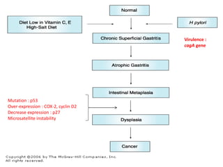 Virulence :
cagA gene
Mutation : p53
Over-expression : COX-2, cyclin D2
Decrease expression : p27
Microsatellite instability
 