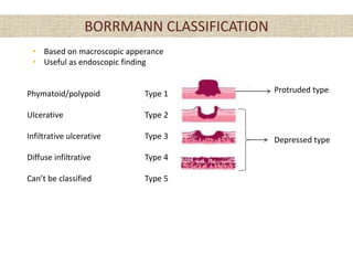 • Based on macroscopic apperance
• Useful as endoscopic finding
BORRMANN CLASSIFICATION
Protruded type
Depressed type
Type 1
Type 2
Type 3
Type 4
Type 5
Phymatoid/polypoid
Ulcerative
Infiltrative ulcerative
Diffuse infiltrative
Can’t be classified
 