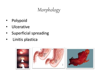 Morphology
• Polypoid
• Ulcerative
• Superficial spreading
• Linitis plastica
 