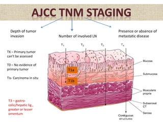 T1a
T1b
Depth of tumor
invasion Number of involved LN
Presence or absence of
metastatic disease
TX – Primary tumor
can’t be assessed
T0 – No evidence of
primary tumor
Tis- Carcinoma in situ
Mucosa
Submucosa
Muscularis
propria
Subserosal
CT
Serosa
T3 – gastro-
colic/hepatic lig.,
greater or lesser
omentum
 