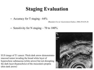 Staging Evaluation
– Accuracy for T staging - 64%
Bhandari S et al. Gastrointest Endosc 2004;59:619-26
– Sensitivity for N staging – 70 to 100%
EUS image of T1 cancer. Thick dark arrow demonstrates
mucosal tumor invading the broad white layer of
hyperechoic submucosa (white arrow) but not disrupting
the dark layer (hypoechoic) of the muscularis propria
(thin dark arrow)
 