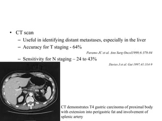 • CT scan
– Useful in identifying distant metastases, especially in the liver
– Accuracy for T staging - 64%
Paramo JC et al. Ann Surg Oncol1999;6:379-84
– Sensitivity for N staging – 24 to 43%
Davies J et al. Gut 1997;41:314-9
CT demonstrates T4 gastric carcinoma of proximal body
with extension into perigastric fat and involvement of
splenic artery
 