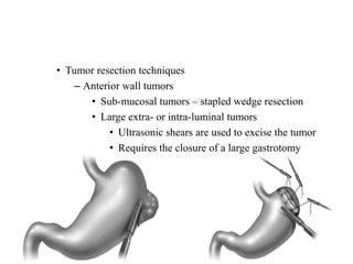 • Tumor resection techniques
– Anterior wall tumors
• Sub-mucosal tumors – stapled wedge resection
• Large extra- or intra-luminal tumors
• Ultrasonic shears are used to excise the tumor
• Requires the closure of a large gastrotomy
 