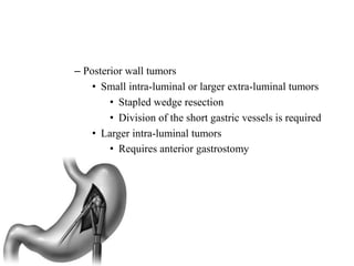 – Posterior wall tumors
• Small intra-luminal or larger extra-luminal tumors
• Stapled wedge resection
• Division of the short gastric vessels is required
• Larger intra-luminal tumors
• Requires anterior gastrostomy
 