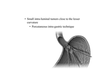 • Small intra-luminal tumors close to the lesser
curvature
• Percutaneous intra-gastric technique
 