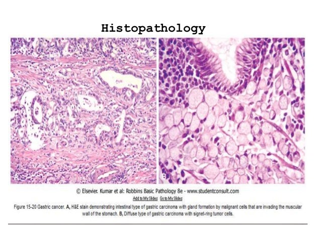 Diffuse Vs Intestinal Gastric Cancer Usmle