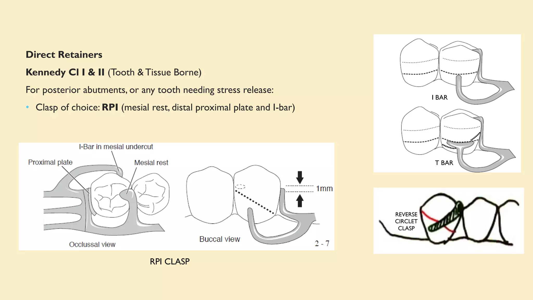 Direct Retainers
Kennedy Cl I & II (Tooth & Tissue Borne)
For posterior abutments, or any tooth needing stress release:
• Clasp of choice: RPI (mesial rest, distal proximal plate and I-bar)
I BAR
T BAR
RPI CLASP
REVERSE
CIRCLET
CLASP
 