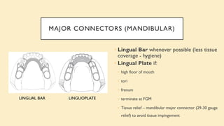 MAJOR CONNECTORS (MANDIBULAR)
LINGUAL BAR LINGUOPLATE
◦ Lingual Bar whenever possible (less tissue
coverage - hygiene)
◦ Lingual Plate if:
◦ high floor of mouth
◦ tori
◦ frenum
◦ terminate at FGM
◦ Tissue relief – mandibular major connector (29-30 gauge
relief) to avoid tissue impingement
 