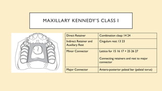 MAXILLARY KENNEDY’S CLASS I
Direct Retainer Combination clasp: 14 24
Indirect Retainer and
Auxiliary Rest
Cingulum rest: 13 23
Minor Connector Lattice for 15 16 17 + 25 26 27
Connecting retainers and rest to major
connector
Major Connector Antero-posterior palatal bar (palatal torus)
 