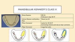 MANDIBULAR KENNEDY’S CLASS II
Direct Retainer RPI: 34
Embrassure clasp: 46 47
Indirect Retainer and Auxiliary
Rest
Mesial rest: 44
Minor Connector Lattice for 35 36 37
Connecting retainers and rest to major connector
Major Connector Lingual bar/ plate
 