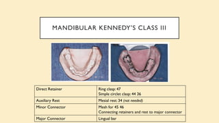 MANDIBULAR KENNEDY’S CLASS III
Direct Retainer Ring clasp: 47
Simple circlet clasp: 44 36
Auxiliary Rest Mesial rest: 34 (not needed)
Minor Connector Mesh for 45 46
Connecting retainers and rest to major connector
Major Connector Lingual bar
 