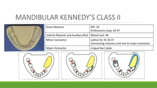 BASIC PRINCIPLES AND FUNDAMENTALS OF CAST PARTIAL DENTURE DESIGNING | PPTX