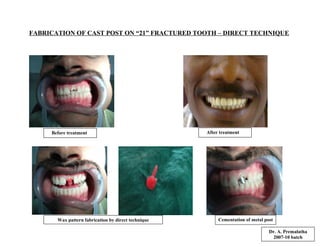 FABRICATION OF CAST POST ON “21” FRACTURED TOOTH – DIRECT TECHNIQUE
Before treatment After treatment
Wax pattern fabrication by direct technique Cementation of metal post
Dr. A. Premalatha
2007-10 batch
 