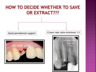 Good periodontal support Crown root ratio minimum 1:1
 