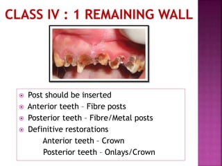  Post should be inserted
 Anterior teeth – Fibre posts
 Posterior teeth – Fibre/Metal posts
 Definitive restorations
Anterior teeth – Crown
Posterior teeth – Onlays/Crown
 